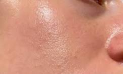 Oily skin