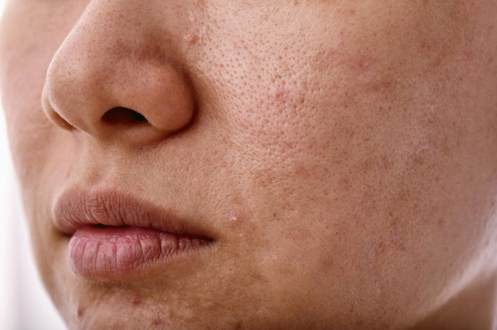 Dull skin