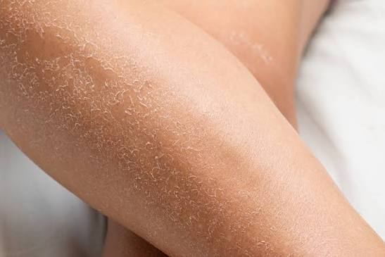Dry skin